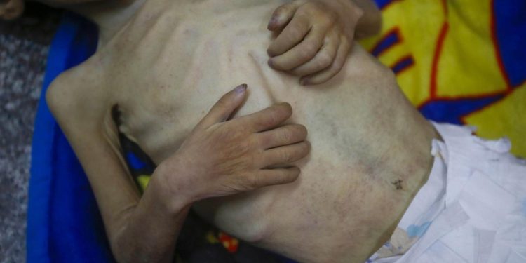 Gazze'de açlıktan ölenlerin sayısı günbegün artıyor