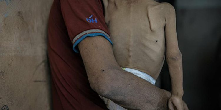 İsrail'in kıtlığı dayattığı Gazzede açlıktan ölenlerin sayısı 263e yükseldi