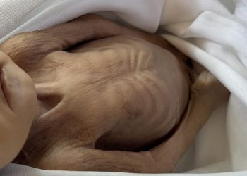 Gazze'de 5 aylık bir bebek daha açlıktan hayatını kaybetti