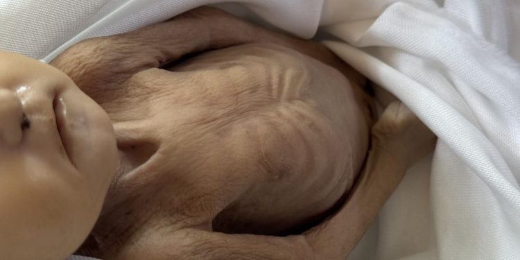 Gazze'de 5 aylık bir bebek daha açlıktan hayatını kaybetti