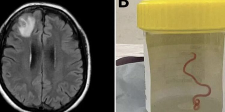 Gölet ve nehirlerde yaşayan solucan, şizofreni tedavisinde kullanılabilir