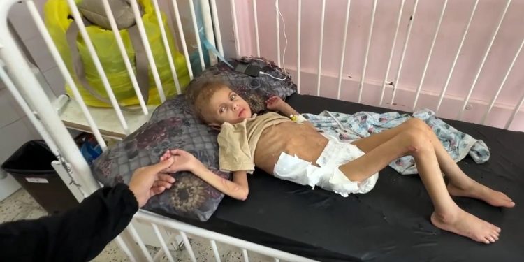 Gazzede yetersiz beslenme sonucu 12 kiloya düşen 7 yaşındaki May yürüme yetisini kaybetti