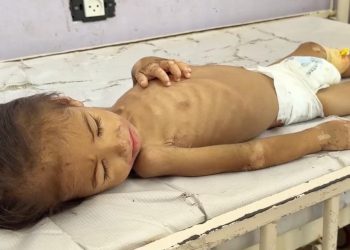 Gazze'de açlık savaşı: 2 yaşındaki İmad yaşam mücadelesi veriyor