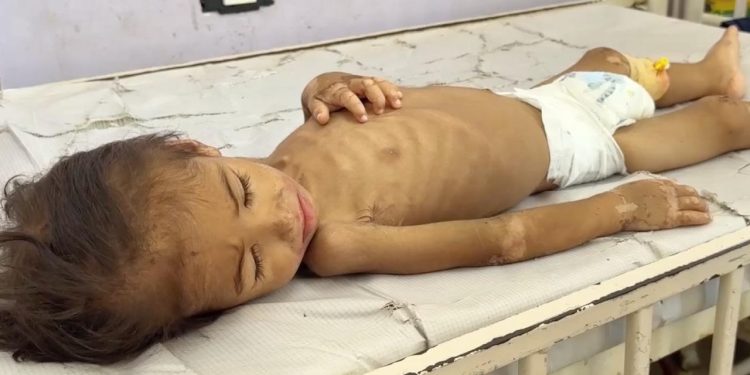 Gazze'de açlık savaşı: 2 yaşındaki İmad yaşam mücadelesi veriyor