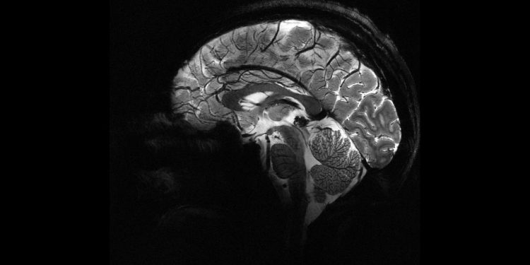 Yapay zeka, epilepsili çocuklarda doktorların gözden kaçırdığı gizli lezyonları buldu