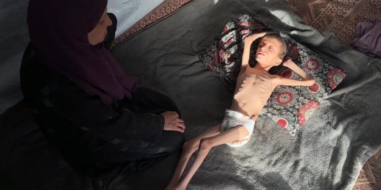 Gazzeli 10 yaşındaki Nafız açlıktan 8 kiloya düştü