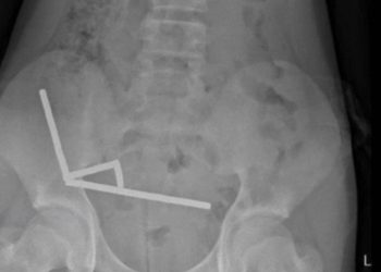 200 mıknatıs yuttu, bağırsaklarının bir kısmını kaybetti