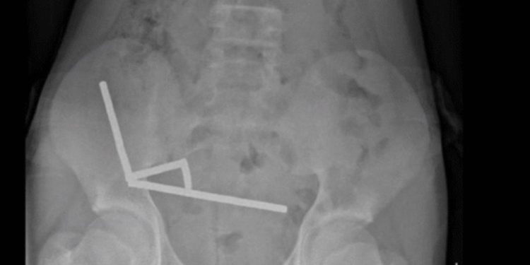 200 mıknatıs yuttu, bağırsaklarının bir kısmını kaybetti